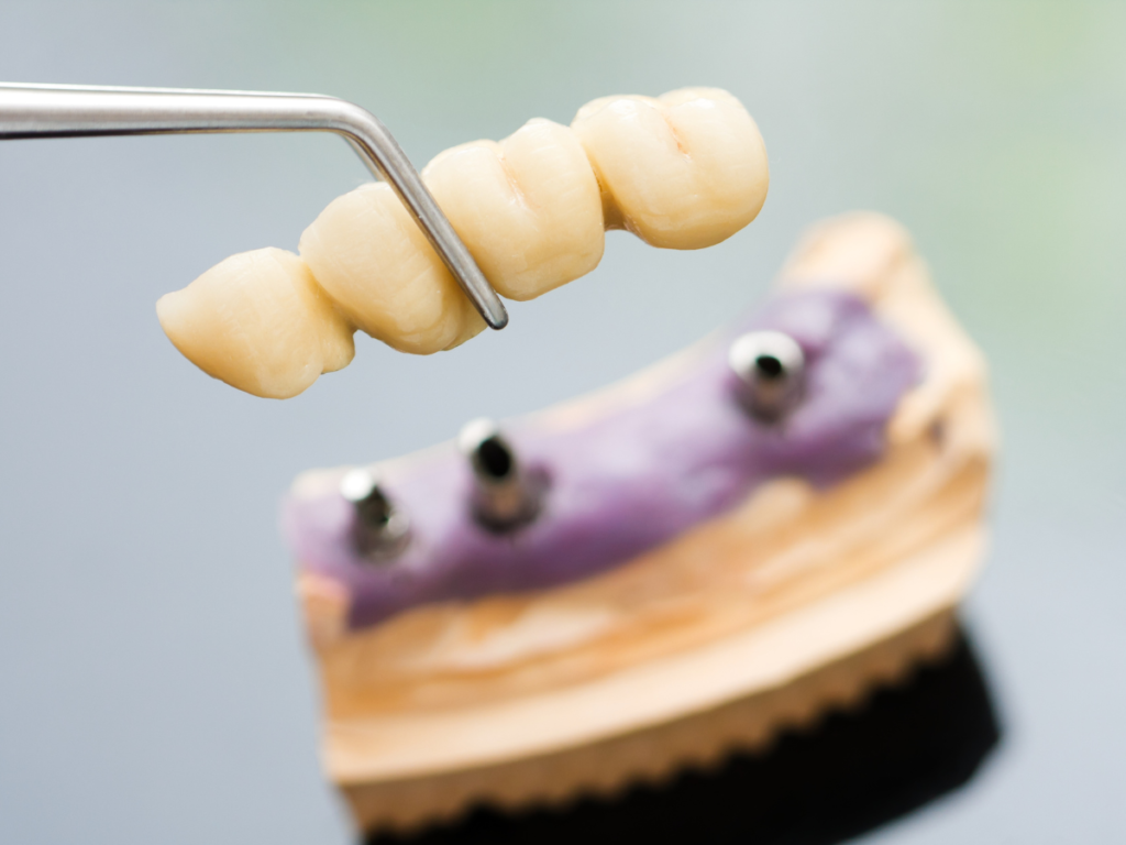 A dentist holding a model of a dental bridge for a patient